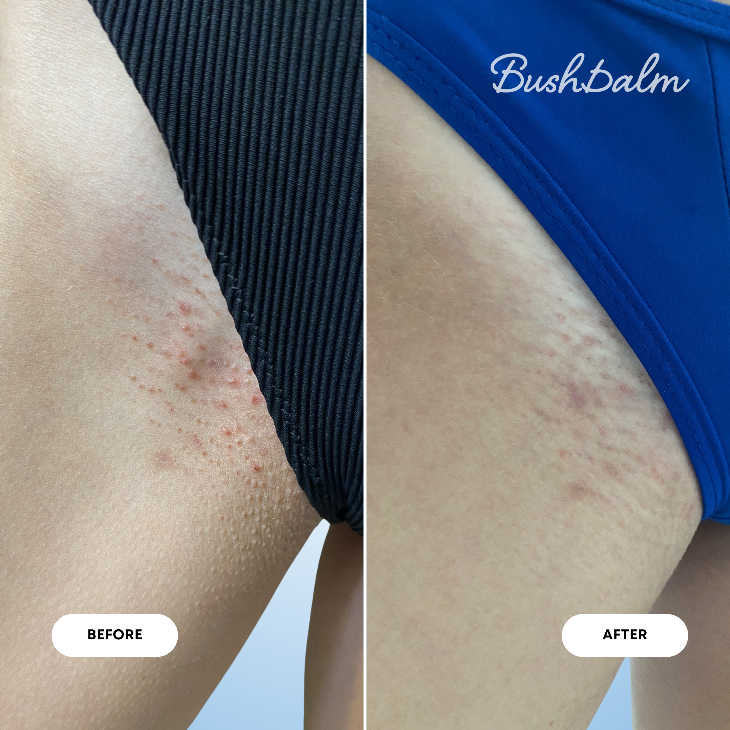 2-Step Ingrown Hair Routine - Nude