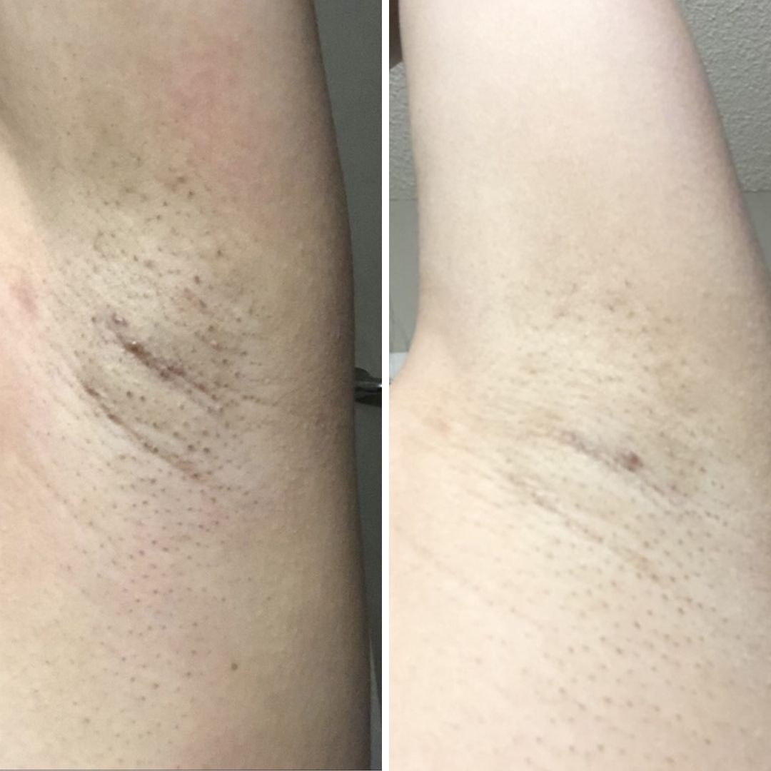 before and after image dark spot oil