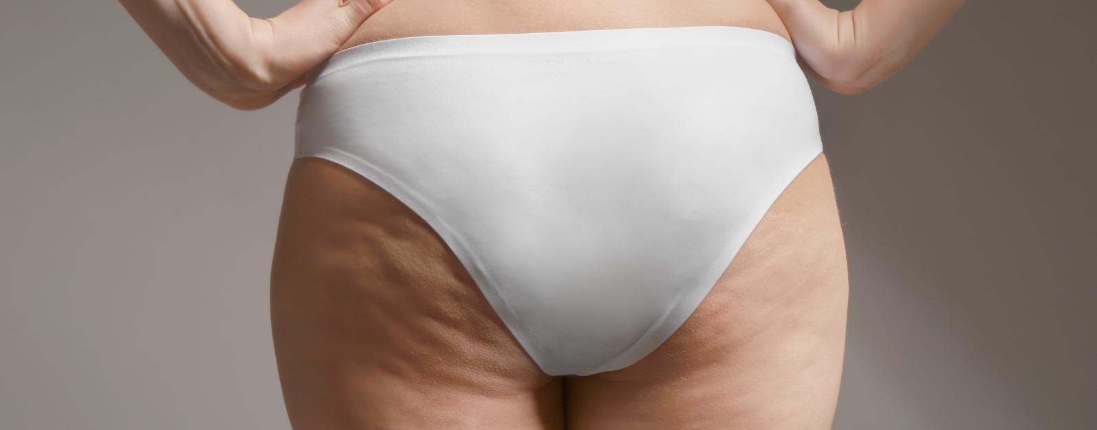 Everything You Need To Know About Cellulite