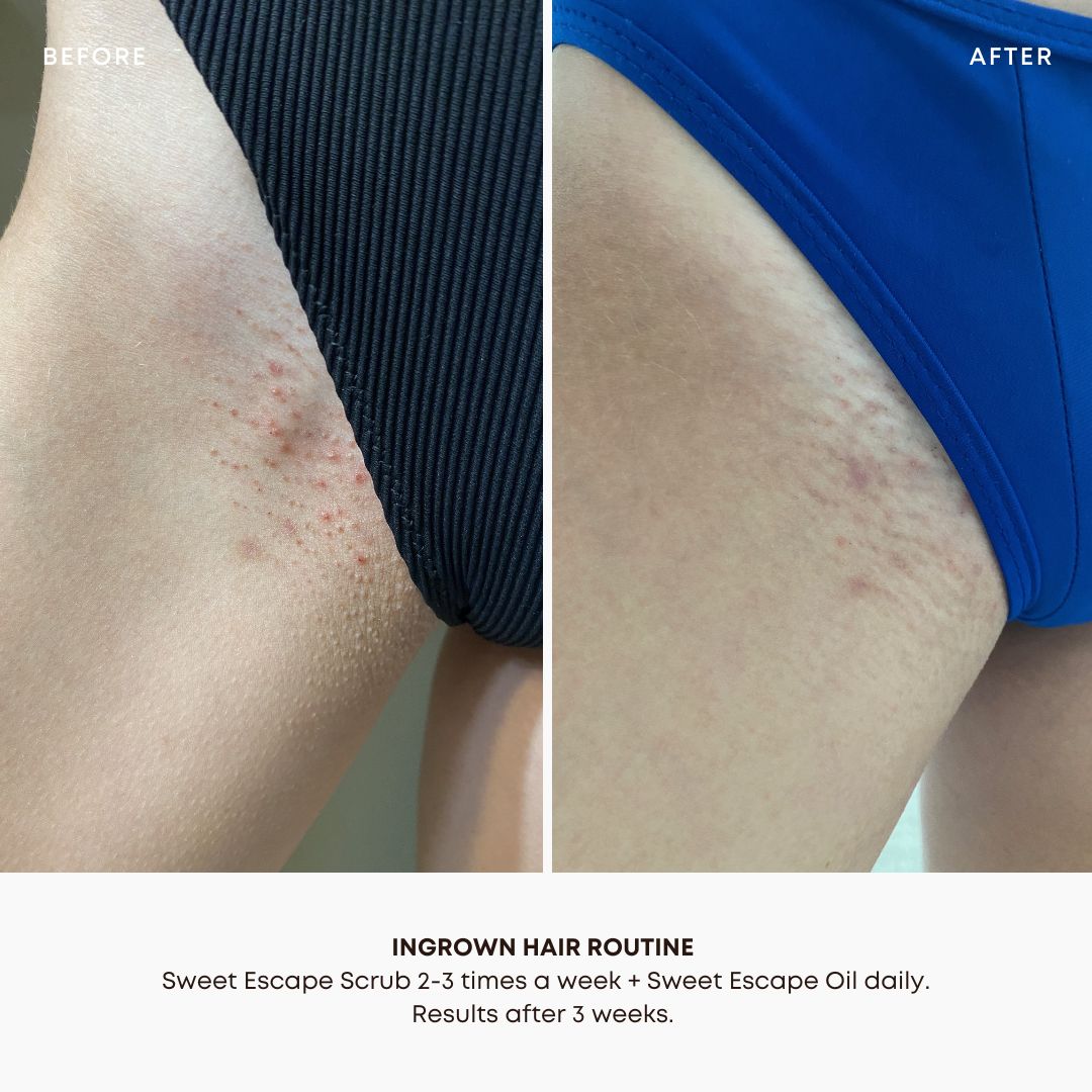 Sweet Escape Ingrown Hair 2 Step Routine
