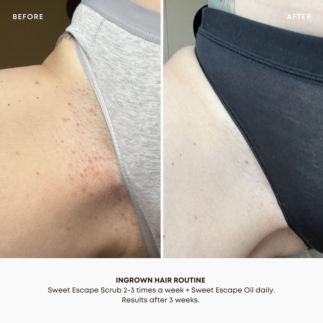 Sweet Escape Ingrown Hair 2 Step Routine