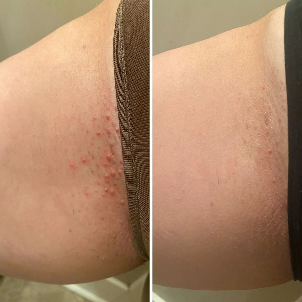 Before and after: skin with ingrown hair bumps, visibly smoother and clearer after treatment