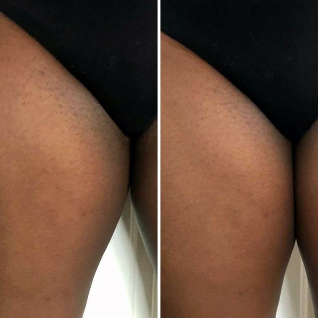 Before and after close-up of dark spots on the inner thigh