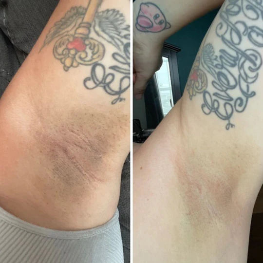 Before and after close-up of underarm darkening