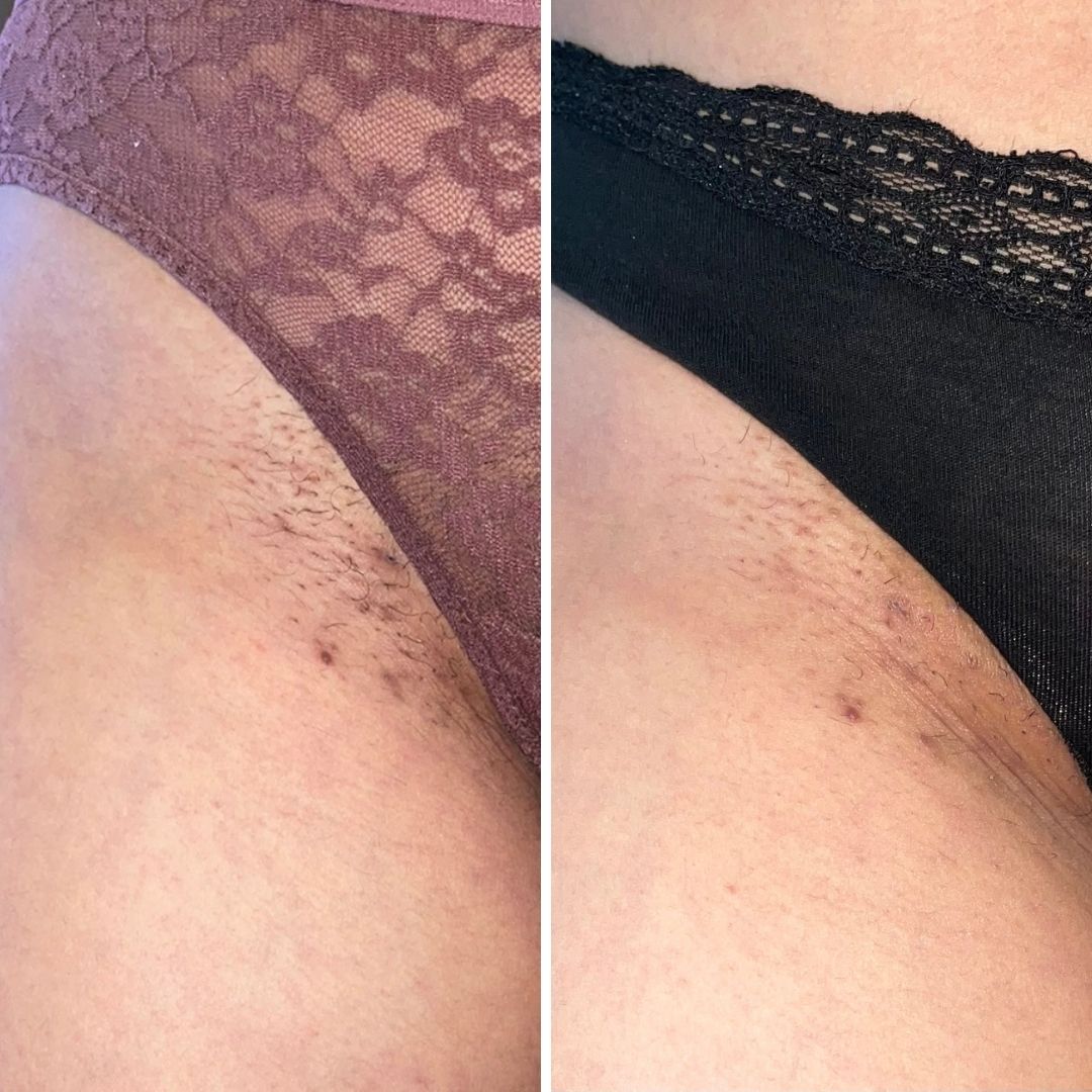 Before and after close-up of ingrown hairs and razor burn on the bikini line