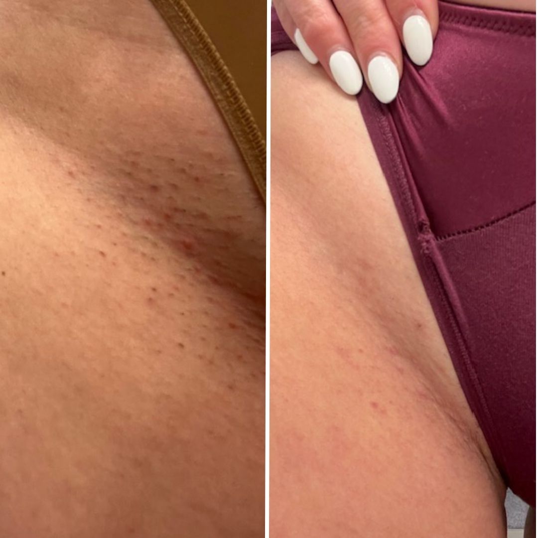 Skin side by side: bumps and irritation on the left, smoother skin on the right