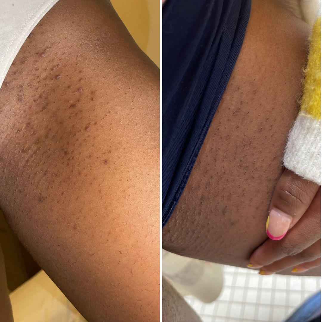 Skin side by side: bumps and irritation on the left, smoother skin on the right