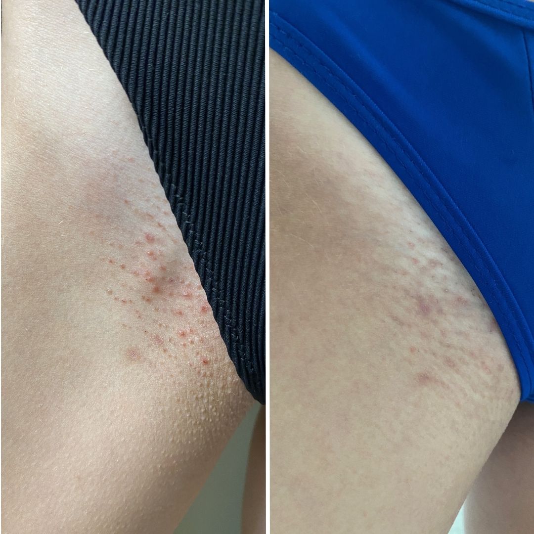 Before and after close-up of razor burn on the inner thigh