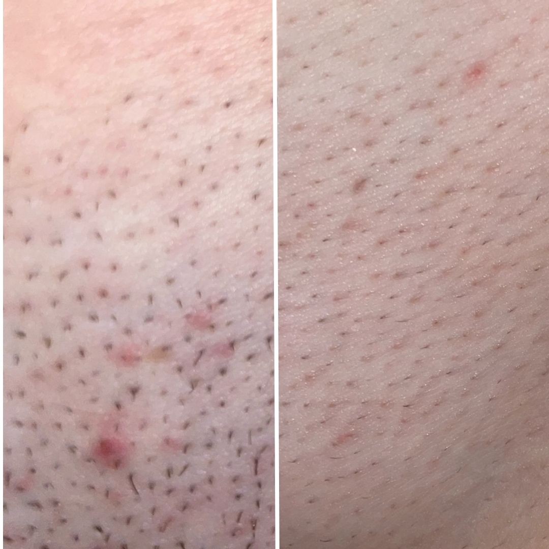 Bikini line side by side: ingrown hairs and redness on the left, calmer skin on the right