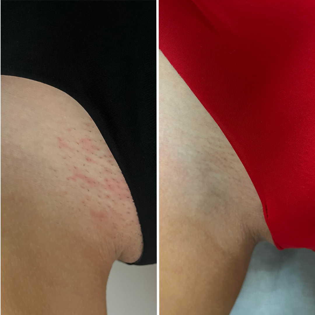 Before and after close-up of ingrown hairs on the bikini line