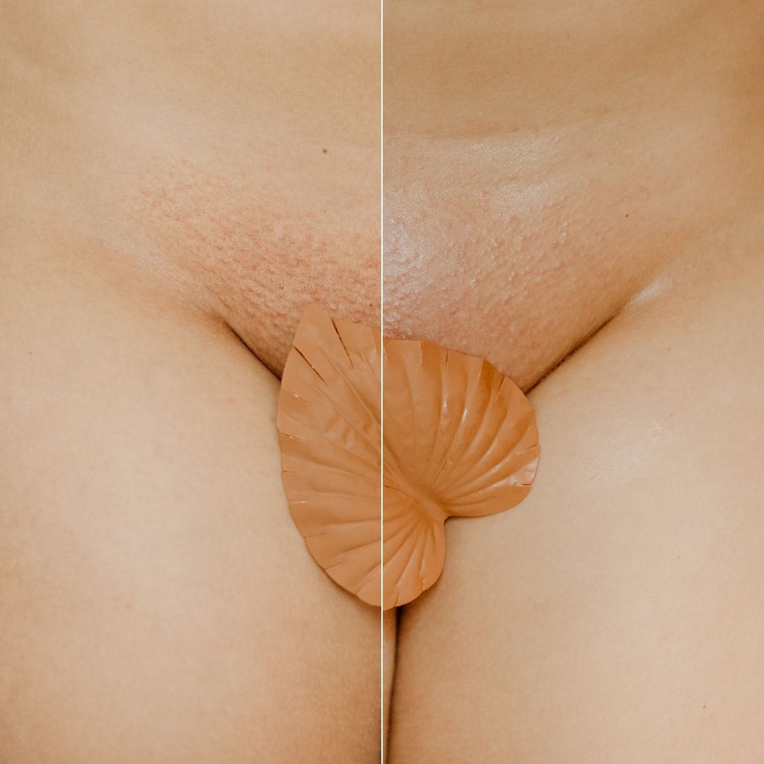 Before and after Vajacial