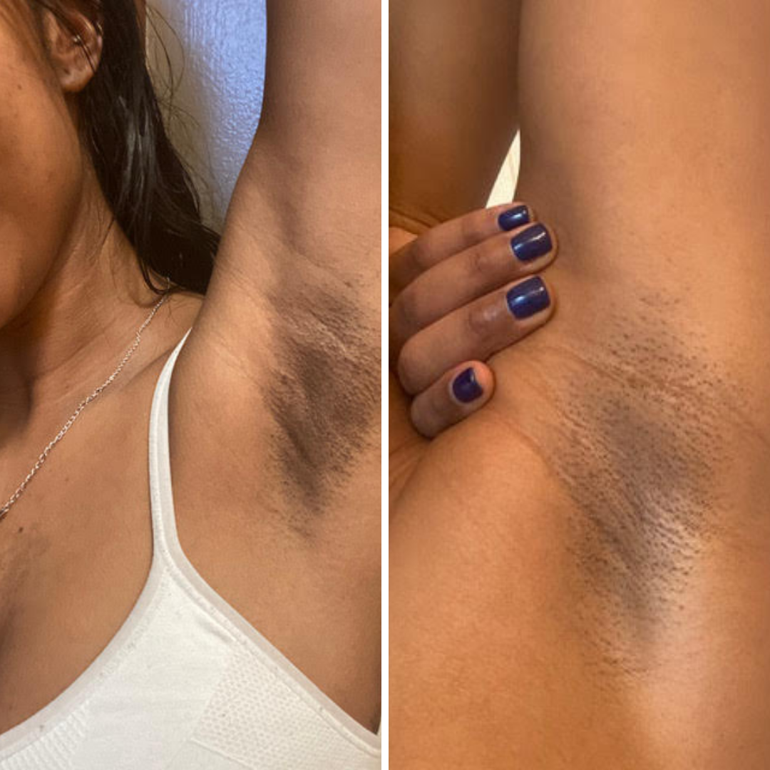 Before and after close-up of underarm darkening
