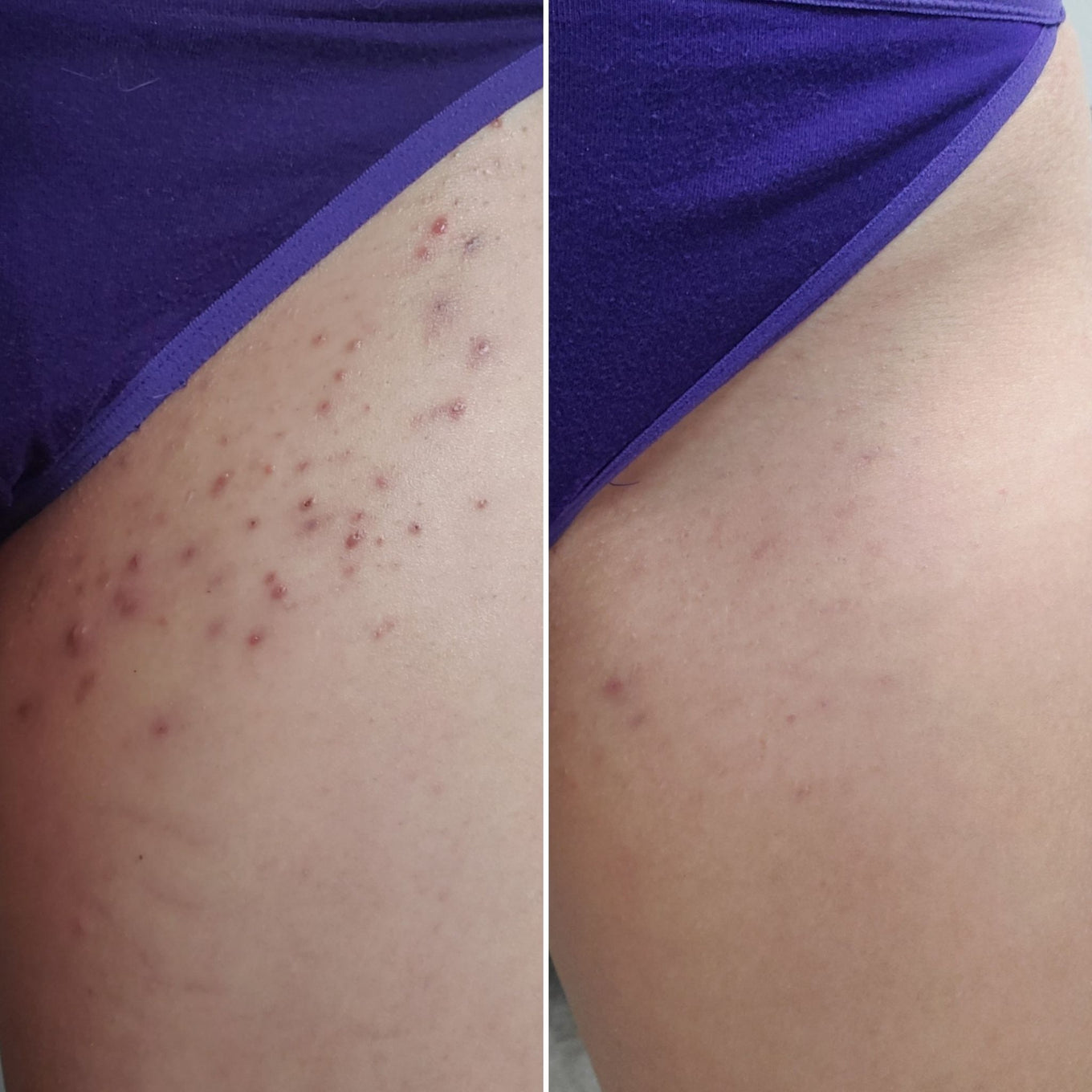 Before and after close-up of ingrown hairs on the bikini line