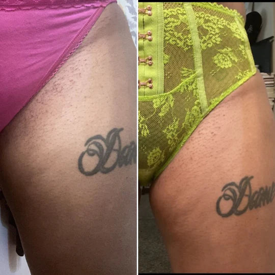 Before and after close-up of dark spots on the upper thigh