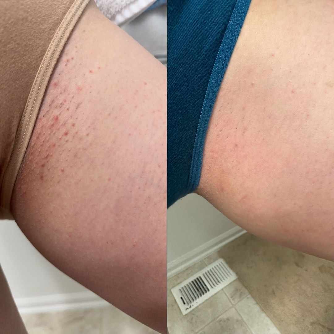 Before and after close-up of ingrown hairs on the bikini line