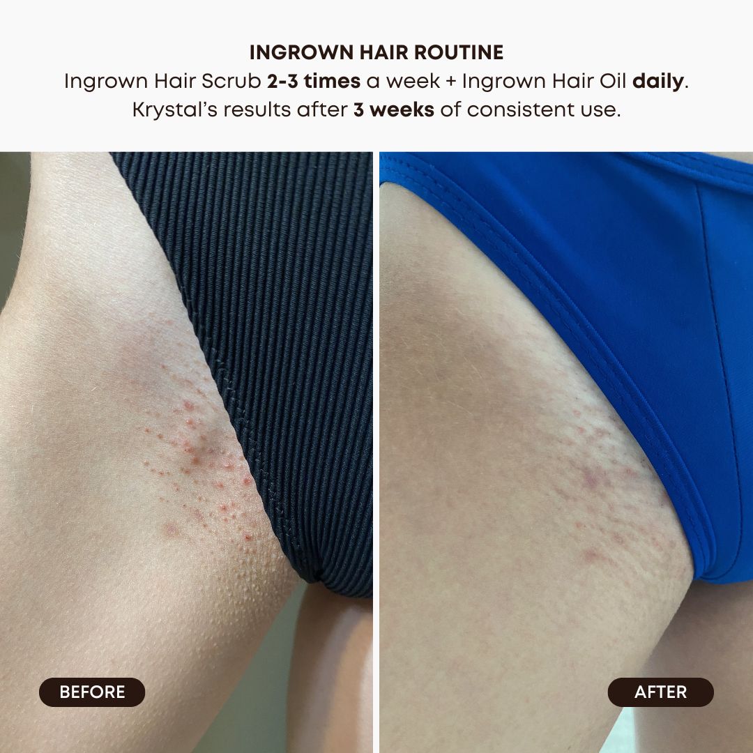Watermelon Sugar Ingrown Hair 2 Step Routine