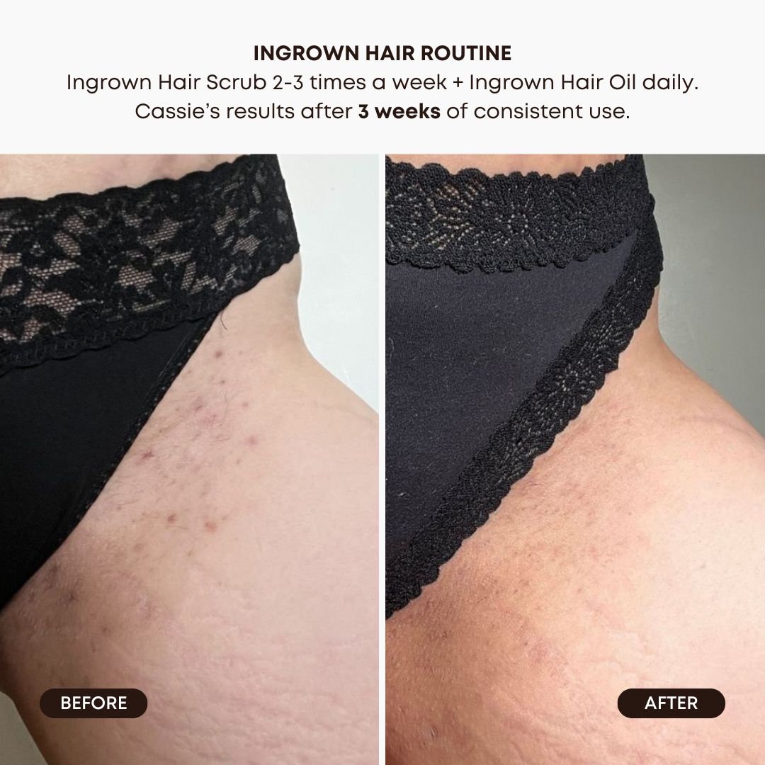 Watermelon Sugar Ingrown Hair 2 Step Routine
