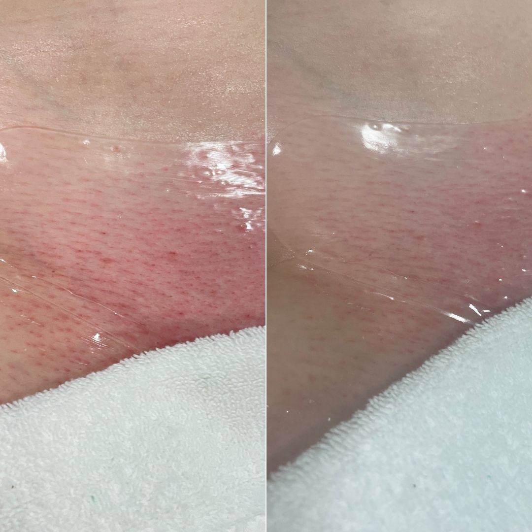 Before and after close-up of the pubic area treated with the vajacial mask