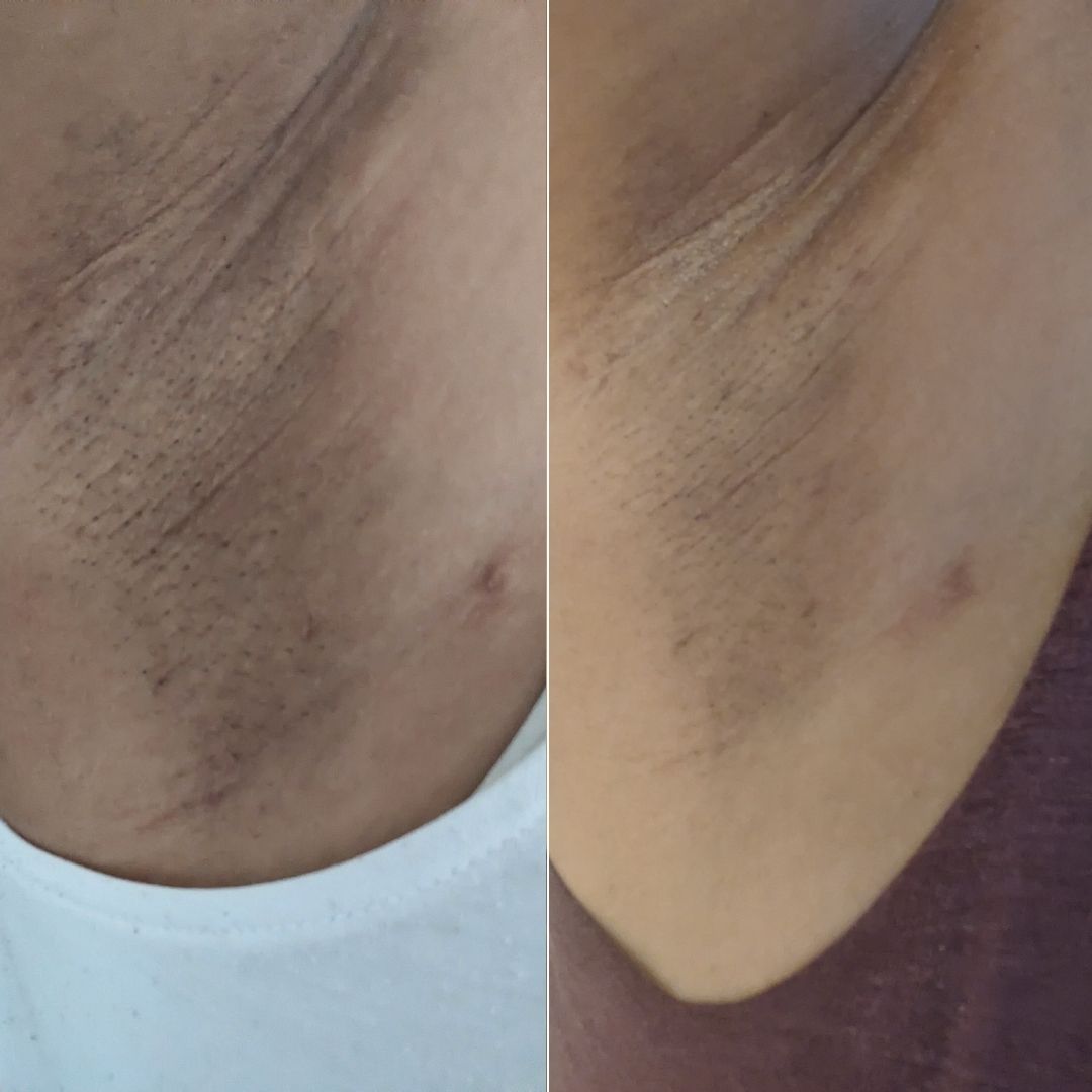 Before and after close-up of underarm darkening