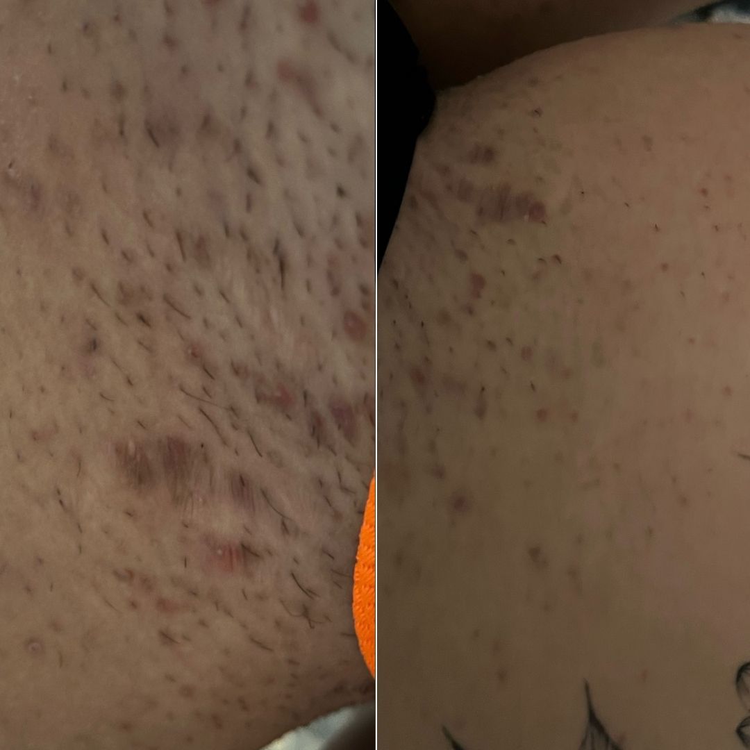 Before and after close-up of ingrown hairs on the thigh