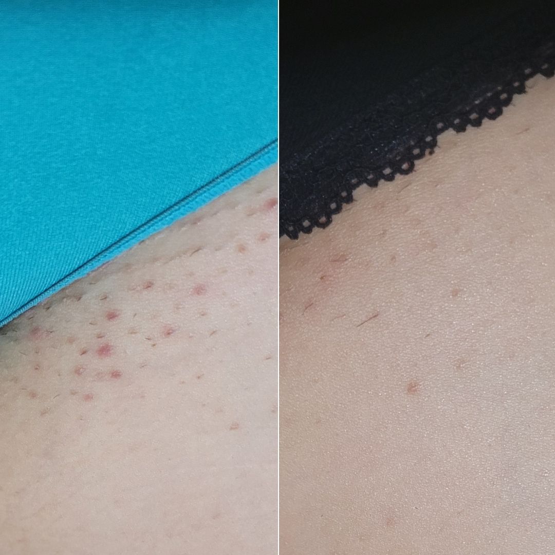 Before and after close-up of razor burn on the bikini line