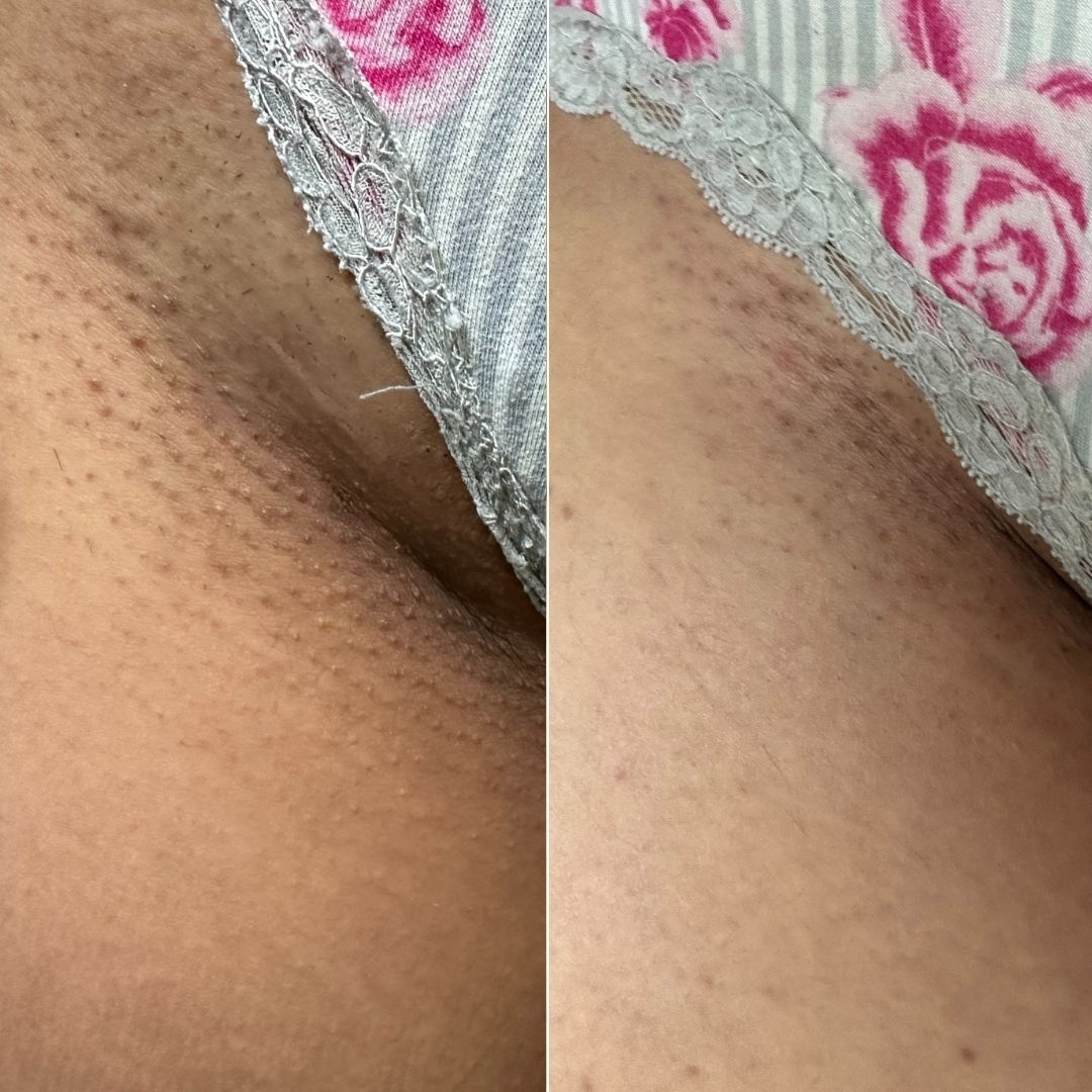 Before and after close-up of ingrown hairs on the bikini line