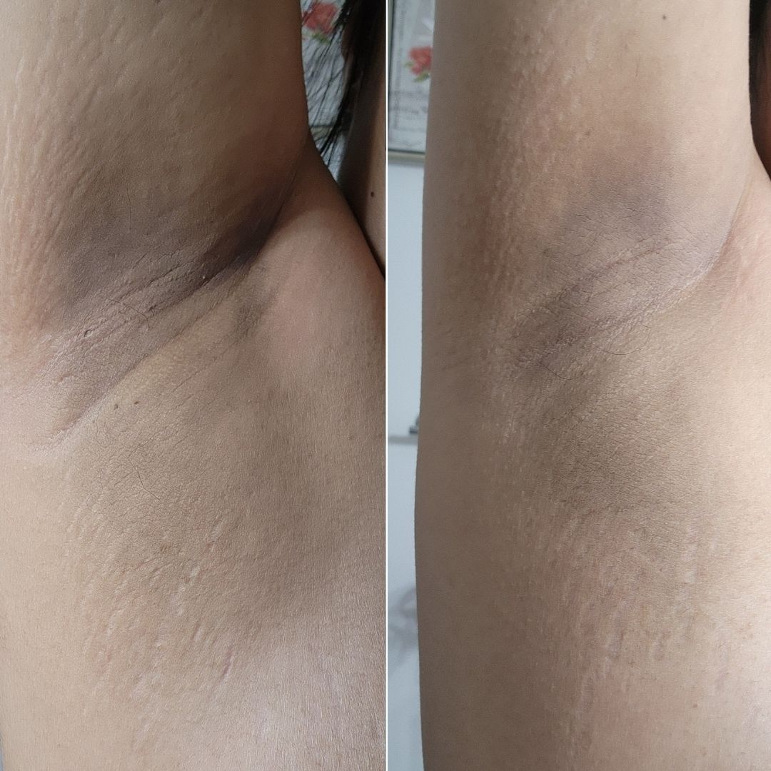 Before and after close-up of underarm darkening