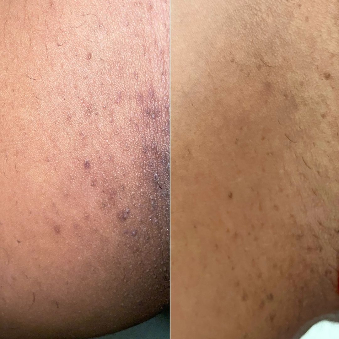 Before and after close-up of ingrown hairs on the thigh