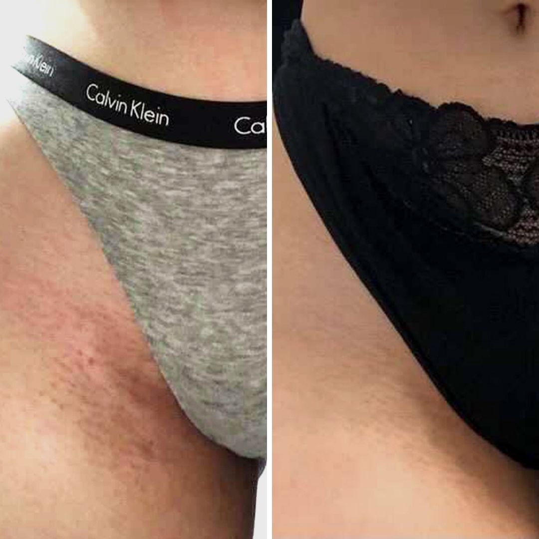 Before and after close-up of razor burn on the bikini line