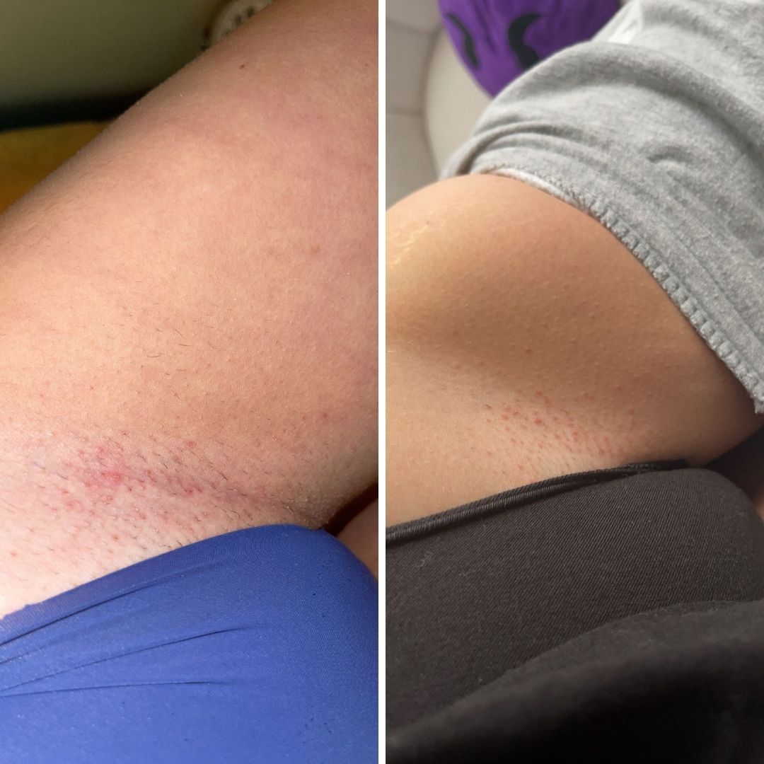 Before and after close-up of razor burn on the inner thigh