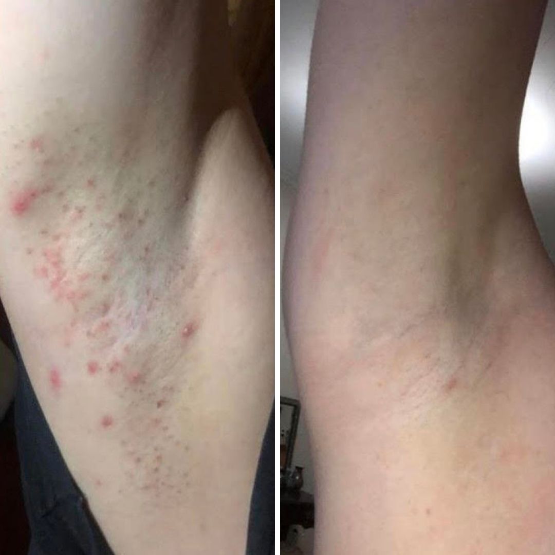 Before and after close-up of ingrown hairs and redness on the underarm