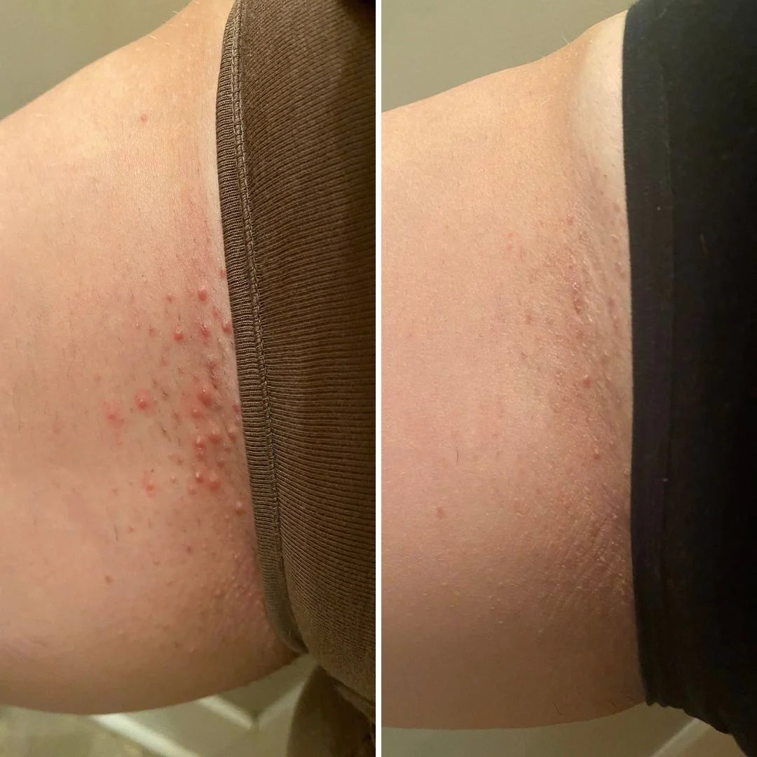 Before and after results from a Bushbalm routine