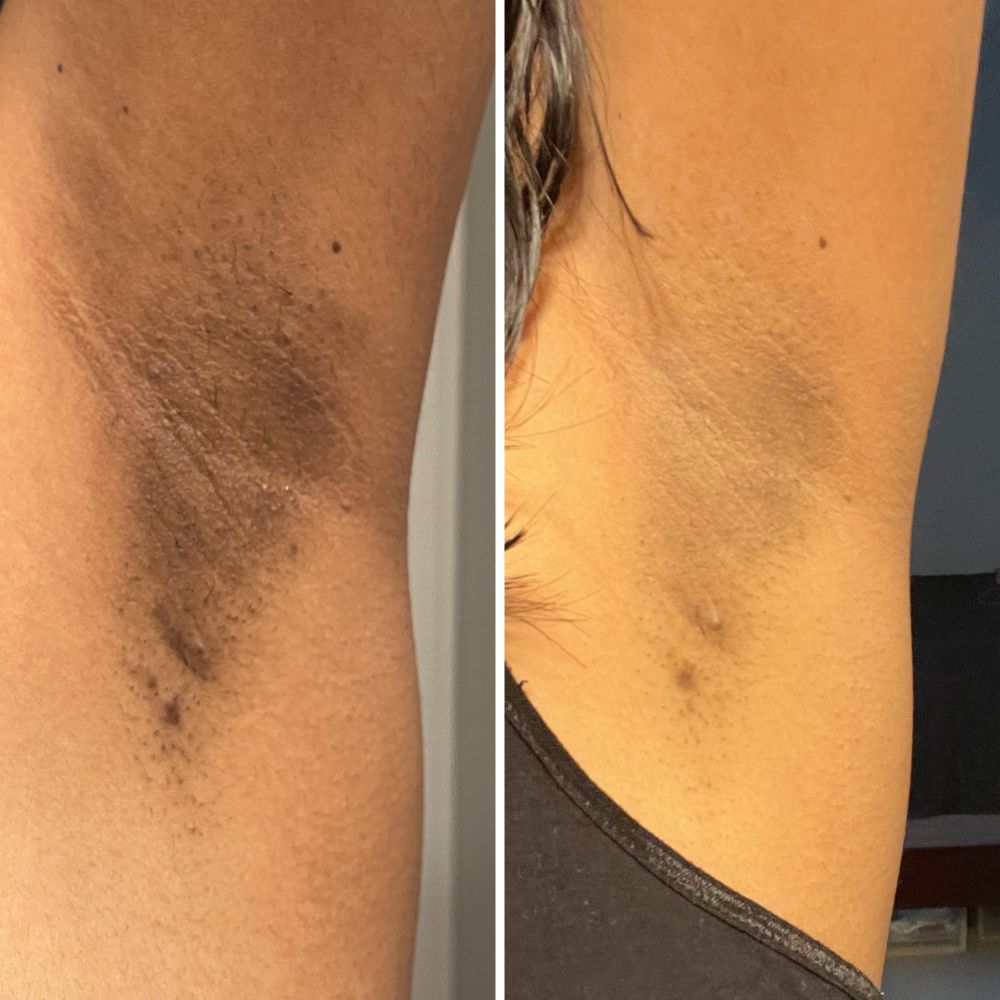 Before and after close-up of underarm hyperpigmentation