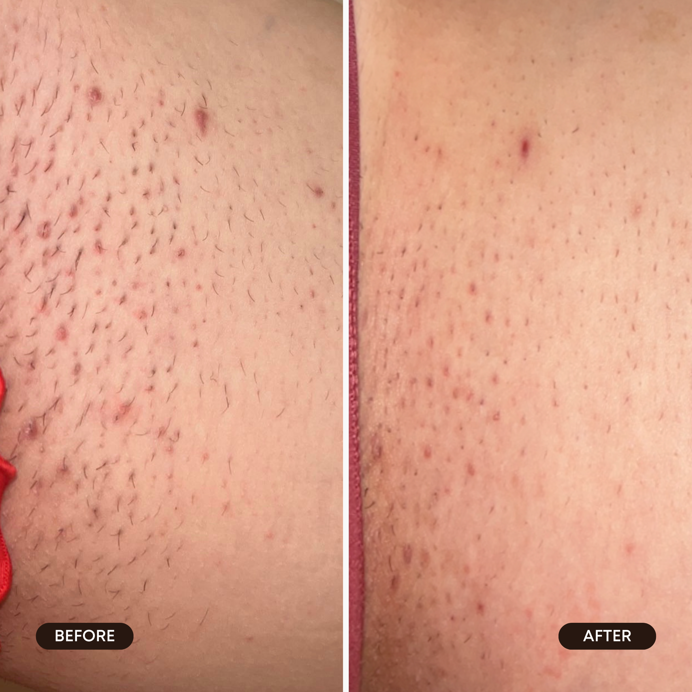 Berry Crush Ingrown Hair 2 Step Routine