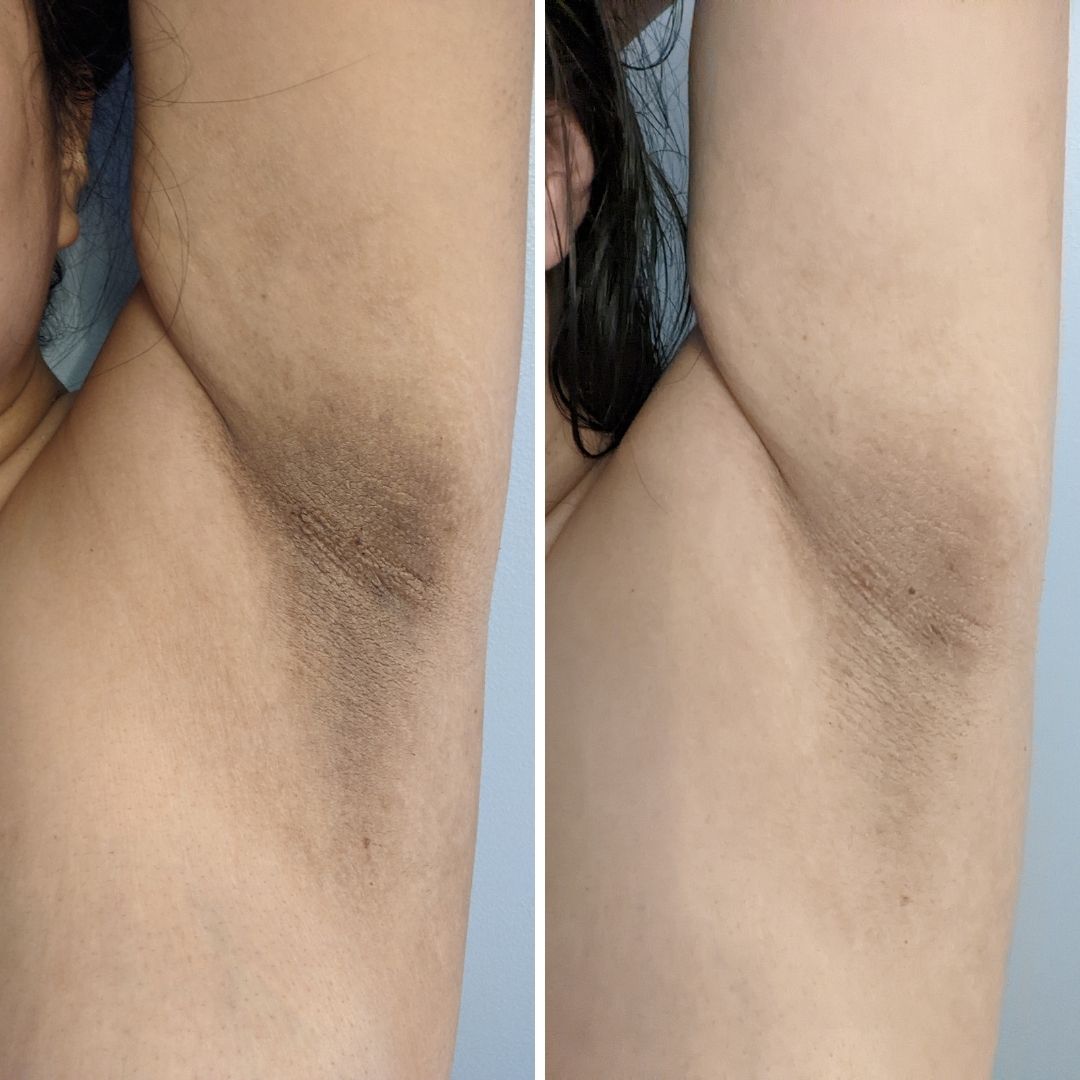 Before and after close-up of underarm darkening