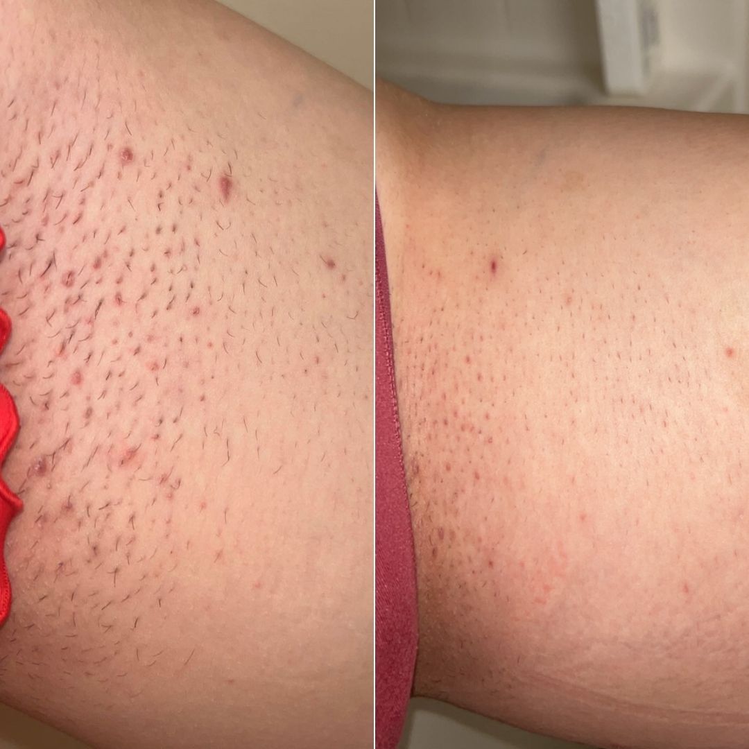 Before and after close-up of ingrown hairs on the bikini line