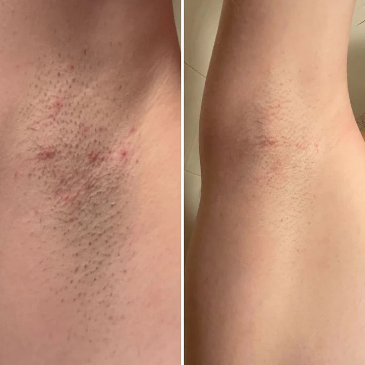 Before and after close-up of underarm darkening